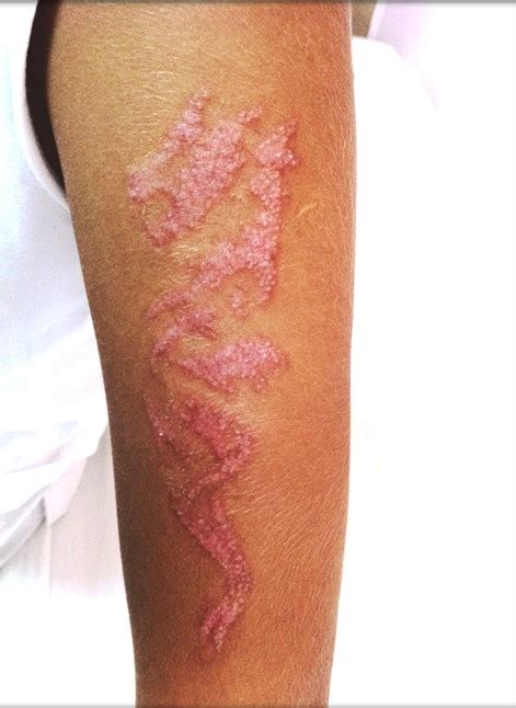 dövme alerjisi tedavisi
